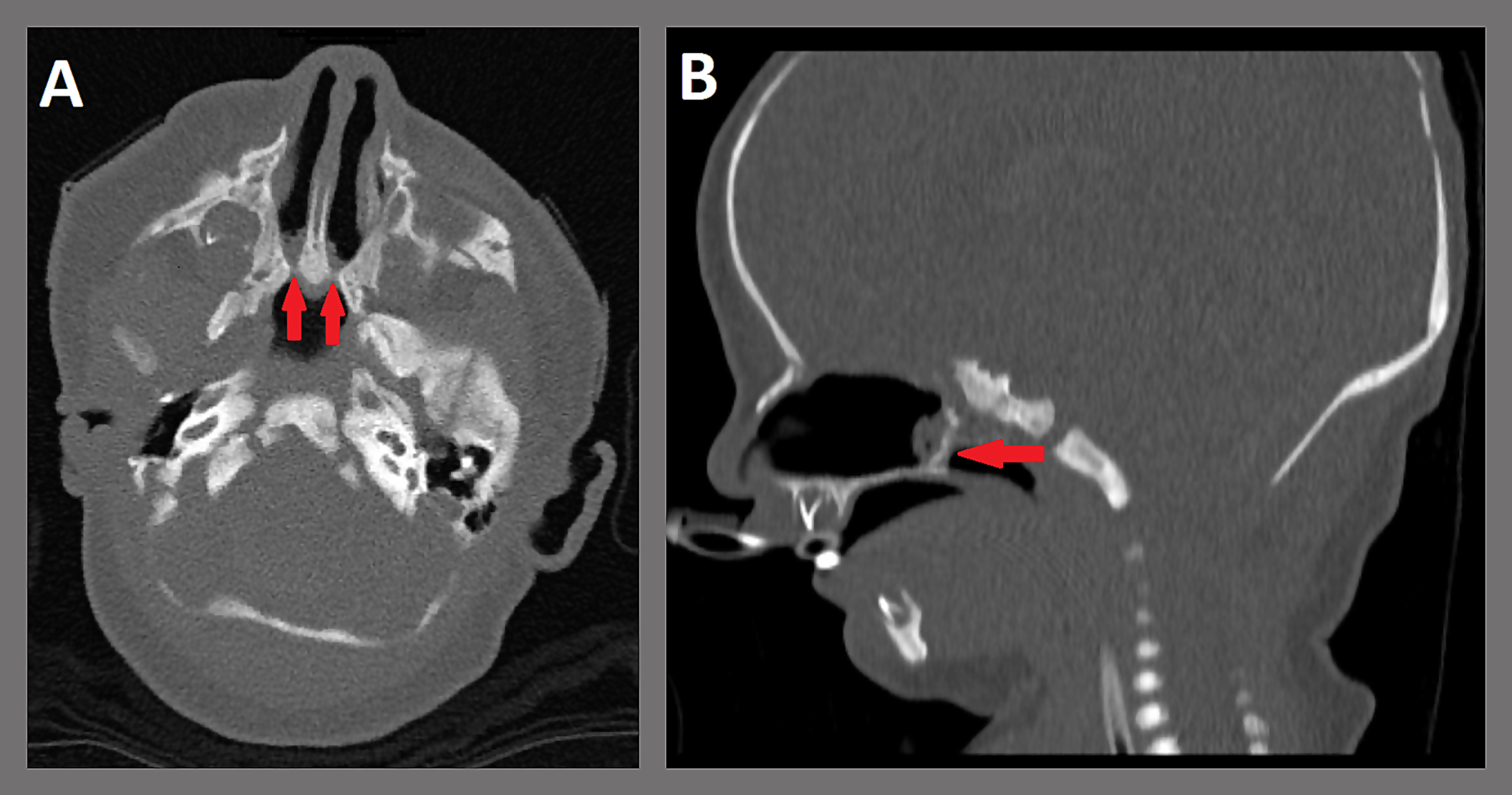 Repair of Choanal Atresia